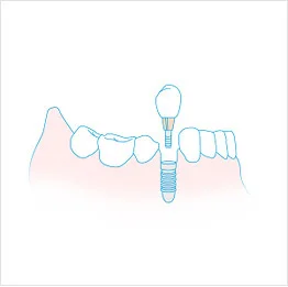 임플란트 일러스트
