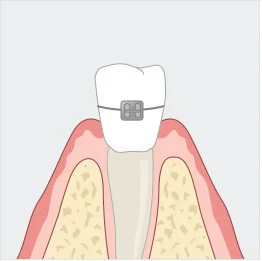 치아교정 일러스트