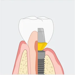 임플란트 치아 일러스트
