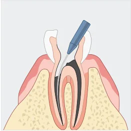 신경치료 일러스트