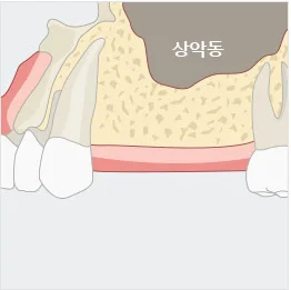 잇몸 일러스트