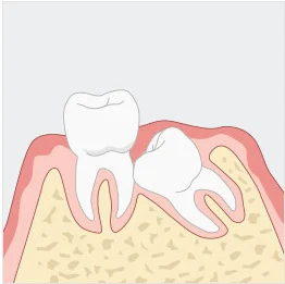 사랑니 일러스트